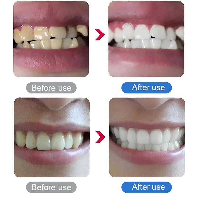 💎Surprise Price ￡9.99!!🦷✨Electric Ultrasonic Dental Scaler for Tartar and Plaque Removal